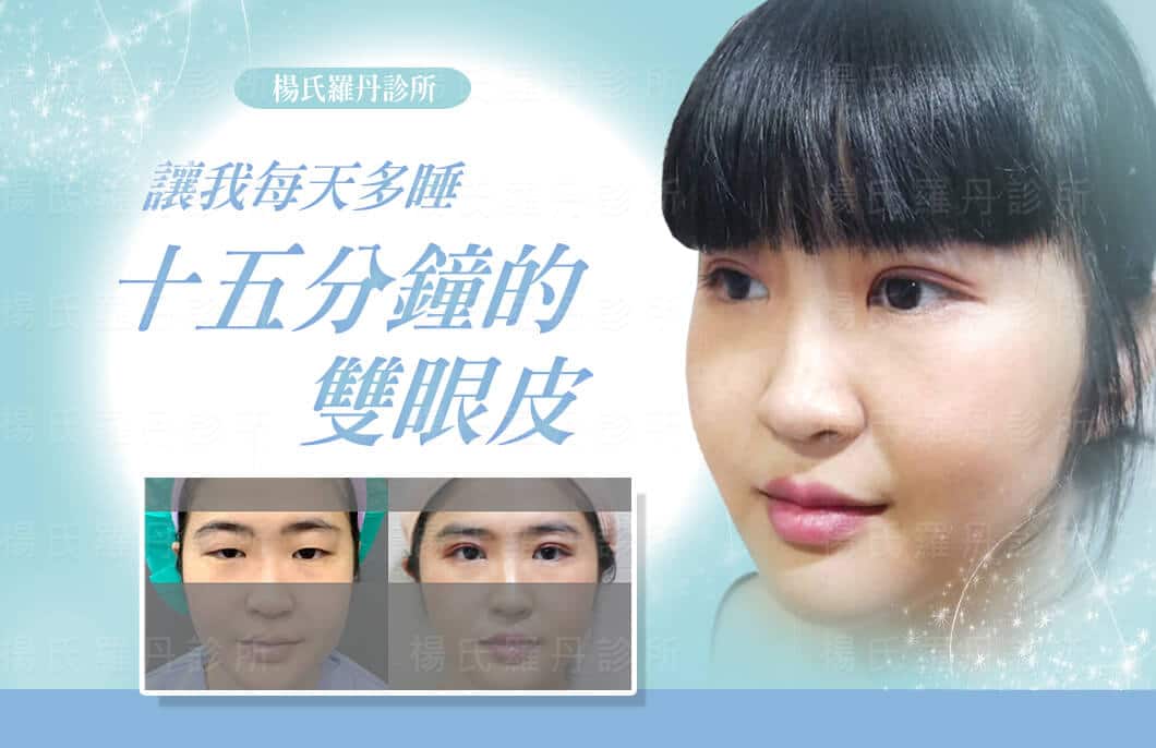 【雙眼皮】原來有了雙眼皮，讓我每天可以多睡十五分鐘